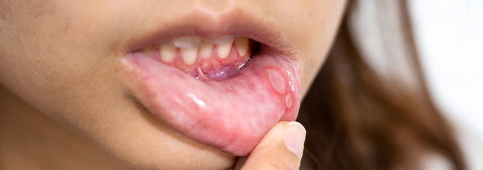 cigarette electronique aphte langue